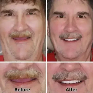 SmileFitPro™–Advanced Custom-Fit Functional Dentures